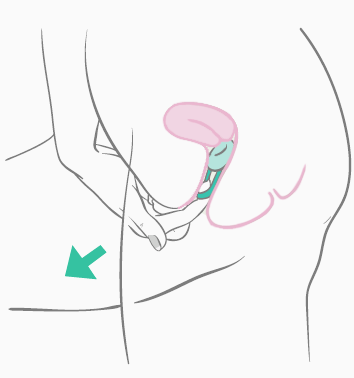 Esponja anticonceptiva Anticonceptivos Bedsider